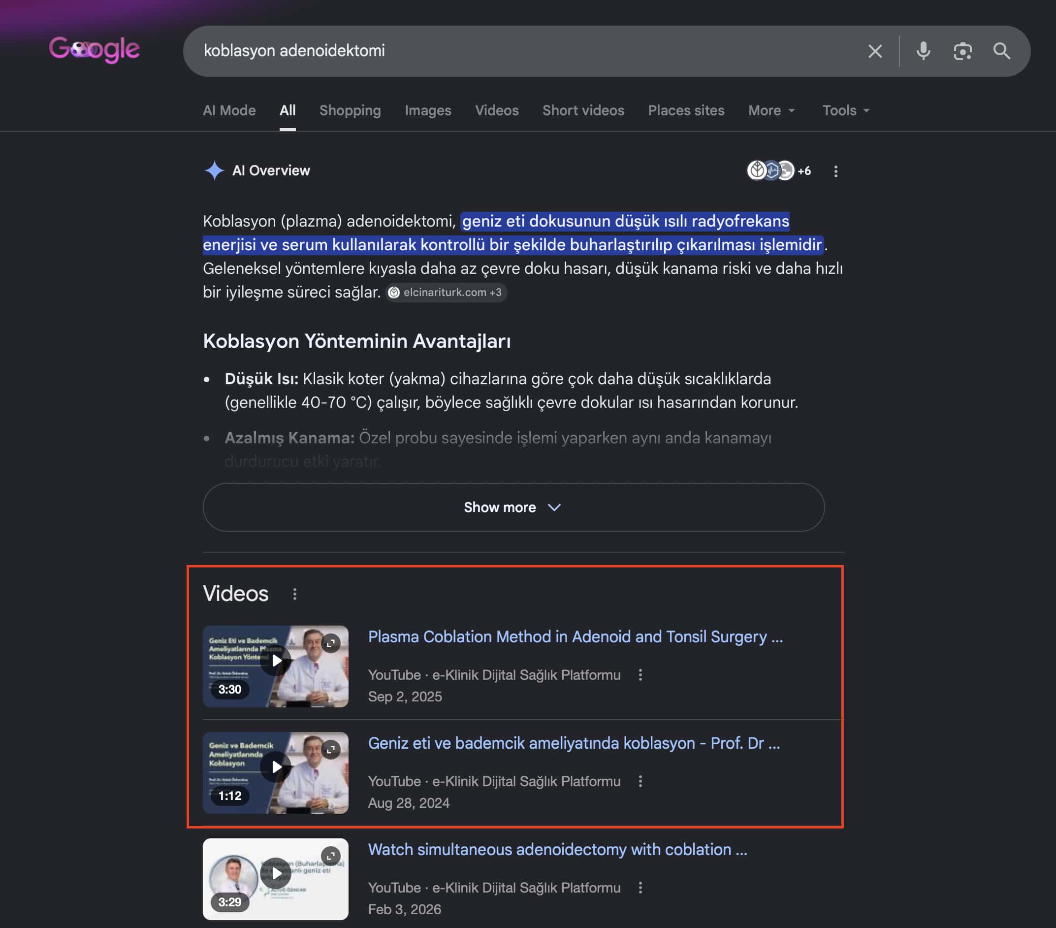 Koblasyon adenoidektomi | e-Klinik